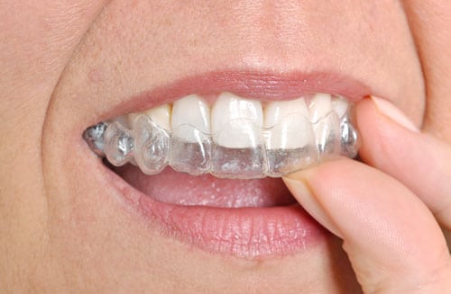 Invisalign First in Singapore