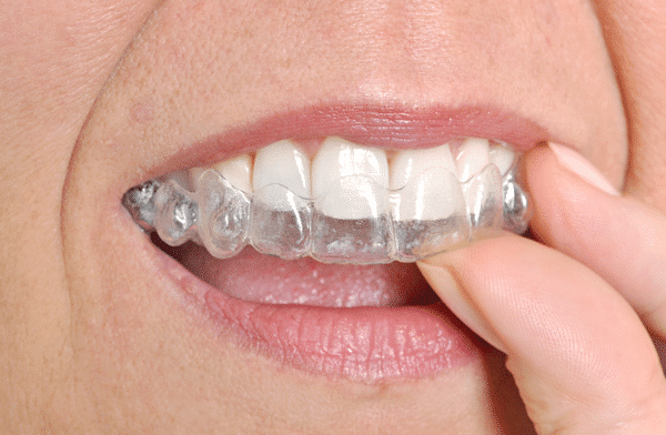 How To Brush And Floss Teeth With Braces